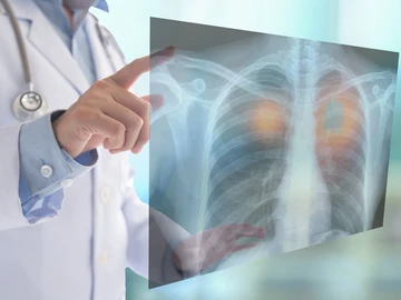 Cómo detectar de forma precoz el cáncer de pulmón, el tumor que más muertes provoca en España