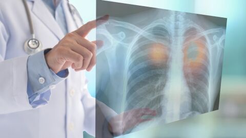 Cómo detectar de forma precoz el cáncer de pulmón, el tumor que más muertes provoca en España
