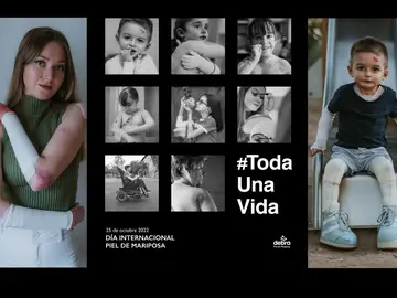 DEBRA Piel de Mariposa lanza la campaña ‘Toda Una Vida’ DEBRA Piel de Mariposa lanza la campaña ‘Toda Una Vida’