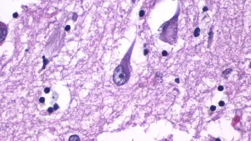 tejidos del hipocampo cerebral con alzhéimer tejidos del hipocampo cerebral con alzhéimer