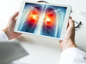 Cáncer de pulmón Cáncer de pulmón