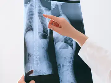 El cáncer de pulmón cambia su perfil de paciente, con más impacto en mujeres y jóvenes El cáncer de pulmón cambia su perfil de paciente, con más impacto en mujeres y jóvenes