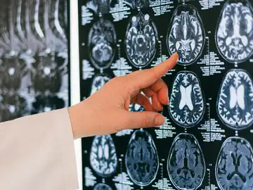 El cerebro cambia muy rápido en determinados momentos de nuestra vida y estudiarlo es clave para anticiparnos a la demencia El cerebro cambia muy rápido en determinados momentos de nuestra vida y estudiarlo es clave para anticiparnos a la demencia