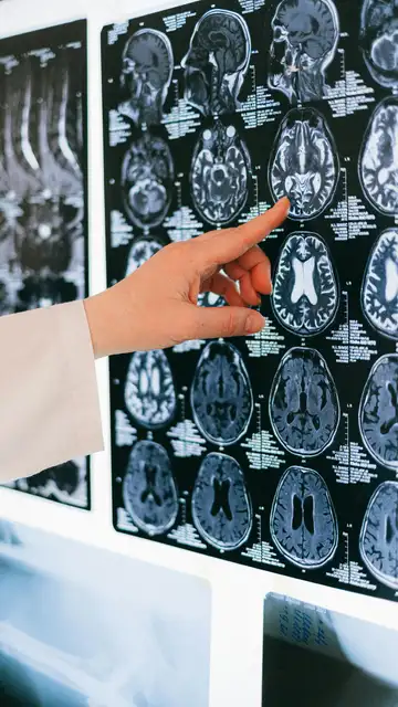 El cerebro cambia muy rápido en determinados momentos de nuestra vida y estudiarlo es clave para anticiparnos a la demencia El cerebro cambia muy rápido en determinados momentos de nuestra vida y estudiarlo es clave para anticiparnos a la demencia