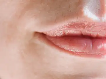 El virus del herpes labial, resistente a los tratamientos El virus del herpes labial, resistente a los tratamientos