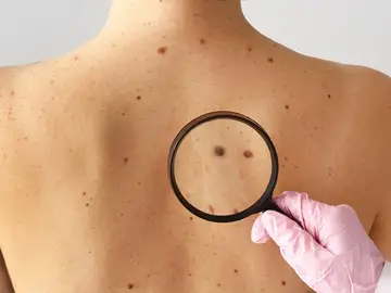 Técnica pionera de medicina nuclear: dos pacientes libres de cáncer de piel no melanoma Técnica pionera de medicina nuclear: dos pacientes libres de cáncer de piel no melanoma
