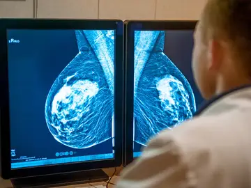 Las tasas de supervivencia a cinco años del cáncer de mama alcanzan ya el 86 % Las tasas de supervivencia a cinco años del cáncer de mama alcanzan ya el 86 %