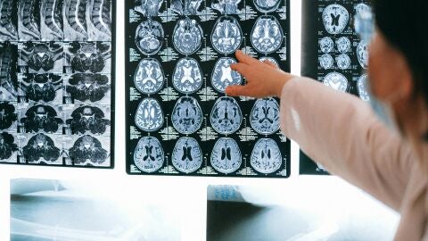La Fundación Reina Sofía impulsa la donación cerebral para investigar enfermedades neurodegenerativas