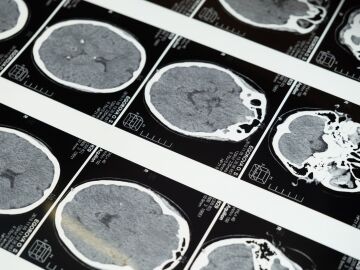 El cerebro adulto sabe repararse a s&iacute; mismo mejor de lo que se pensaba, seg&uacute;n un nuevo estudio