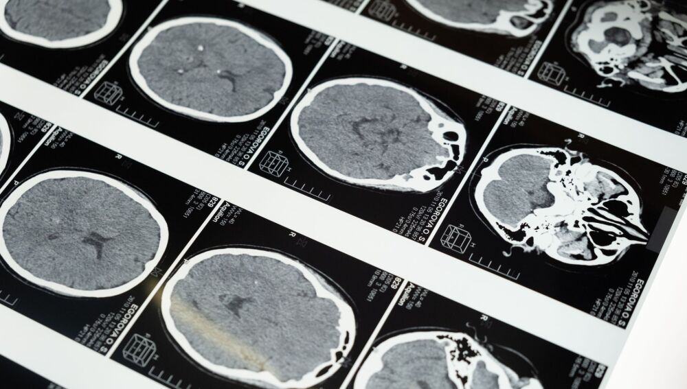 Descubren cómo el gen APOE4 daña los vasos cerebrales y favorece la acumulación de proteínas tóxicas