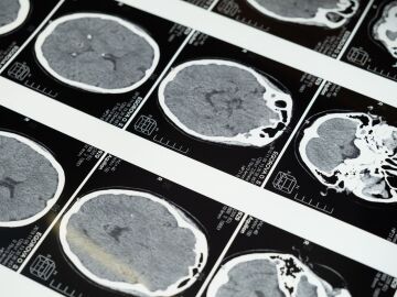 Descubren c&oacute;mo el gen APOE4 da&ntilde;a los vasos cerebrales y favorece la acumulaci&oacute;n de prote&iacute;nas t&oacute;xicas